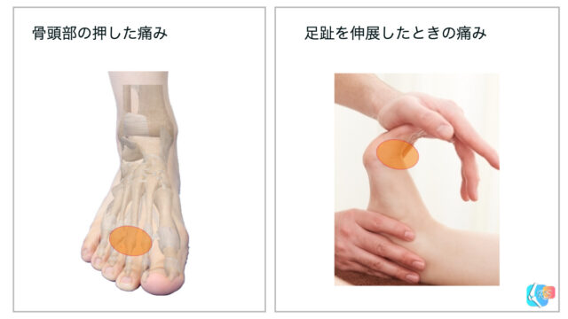 フライバーグ病　痛み